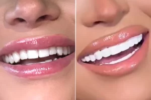 Woman-Spends-20K-on-New-Set-of-Veneers