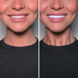 
Woman-Spends-20K-on-New-Set-of-Veneers
