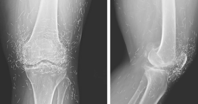 knees