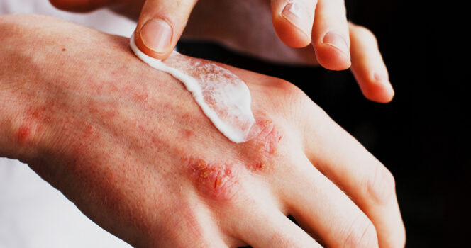 Psoriasis